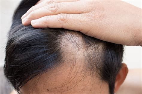 o que causa a alopecia